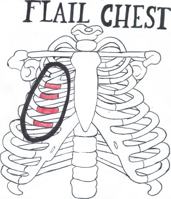 Peds Pearl Flail Chests