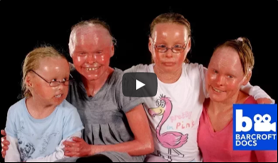 Understanding Harlequin Ichthyosis