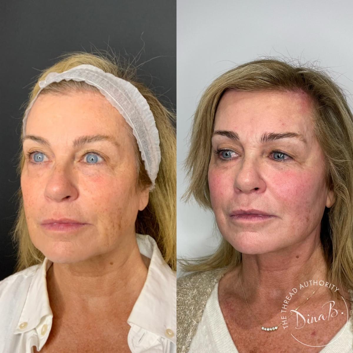 Hands On PDO Thread Lift Training Fort Lauderdale