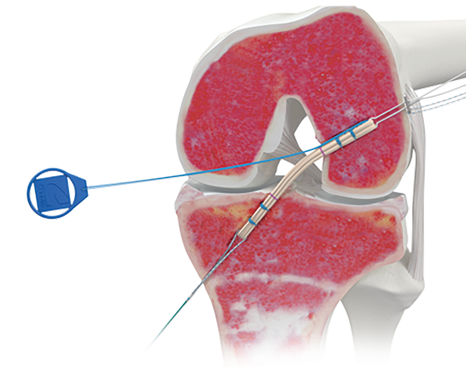 Updates to the ACL Infinity Knee System Disposables