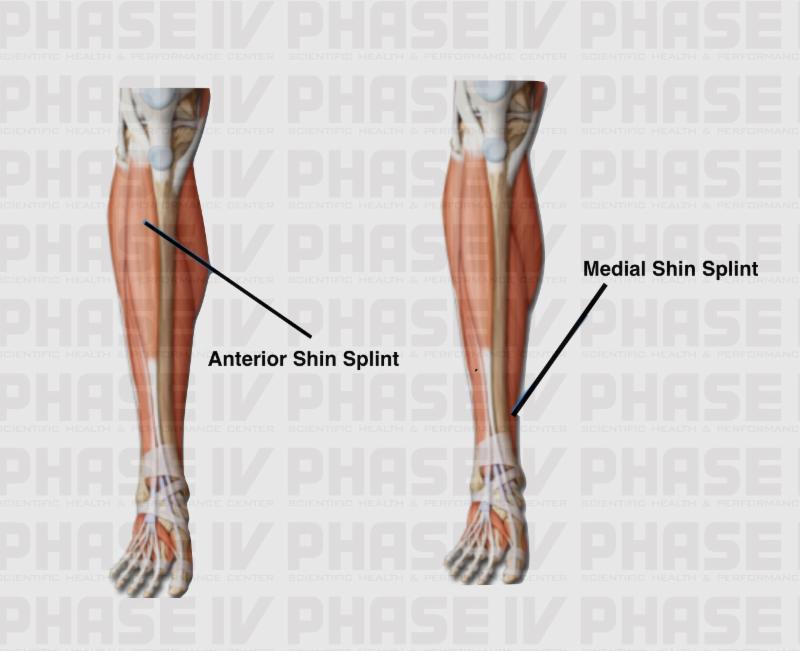 shin splints