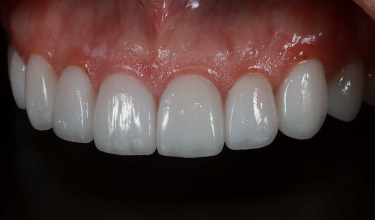 Precision with Itero