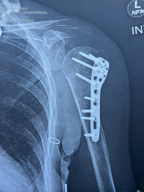shoulder
