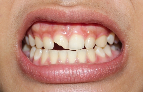 Close-up of a broken tooth with visible cracks and damage. The fractured enamel and dentin expose the tooth s inner layers_ highlighting dental injury and oral health concerns.