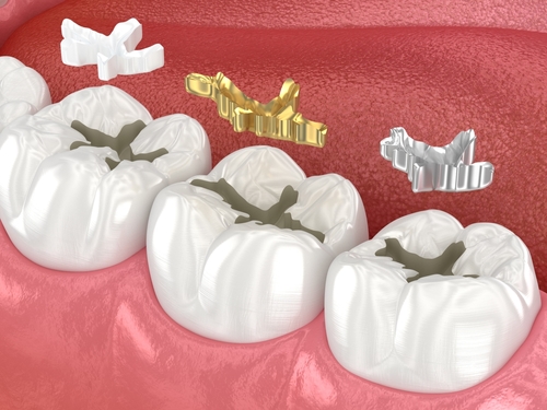 Dental fillings  ceramic_ golden_ metal. Dental 3D illustration