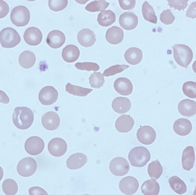 HORIBA's HaemInsight newsletter - blood slide - sickle cell anaemia
