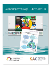 Galerie d’apprentissage : Tuberculose (TB)