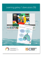 Learning gallery: Tuberculosis (TB)