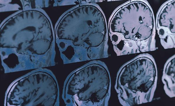 xrays-brain
