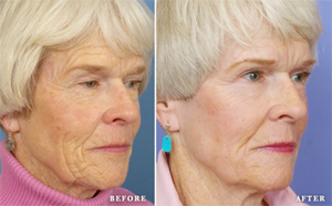 before and after deep chemical peel