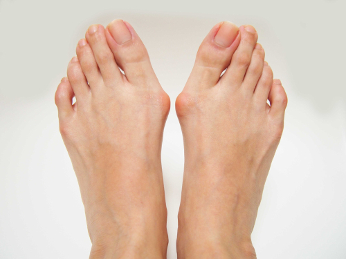 Varus valgus and Hallux valgus_ bunion on white background.