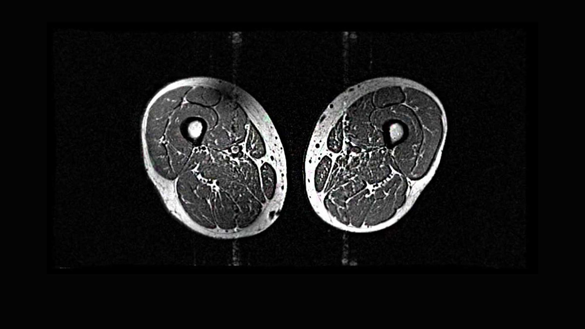 M R I scans showing cross sections of thigh muscles.