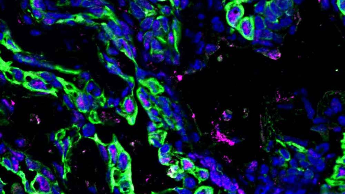 Fluorescent microscopy image of a soft mammary tumor showing relatively little pSTAT3 signaling in pink among green and blue cells.