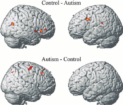fMRI brain comparison autistic brain and control brain