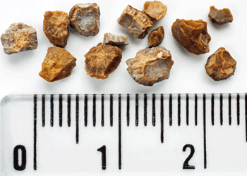 Physical signs that you have a kidney stone may only be noticed if a stone starts to move around the urinary tract.