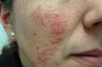 A number of lifestyle factors can trigger rosacea to flare up, including hot and cold weather, sun exposure, stress, and hot or spicy food and drinks. 