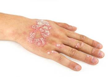 People sometimes confuse psoriasis with eczema as both have to do with dry skin.