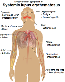 Common symptoms of lupus