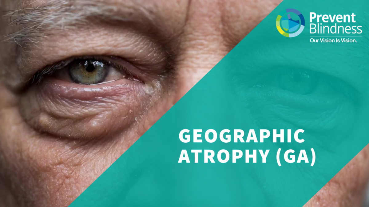 Geographic Atrophy (GA)