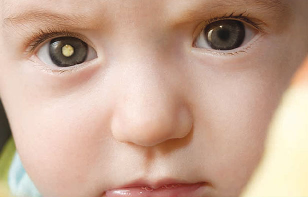 Photo of a baby with retinoblastoma in right eye
