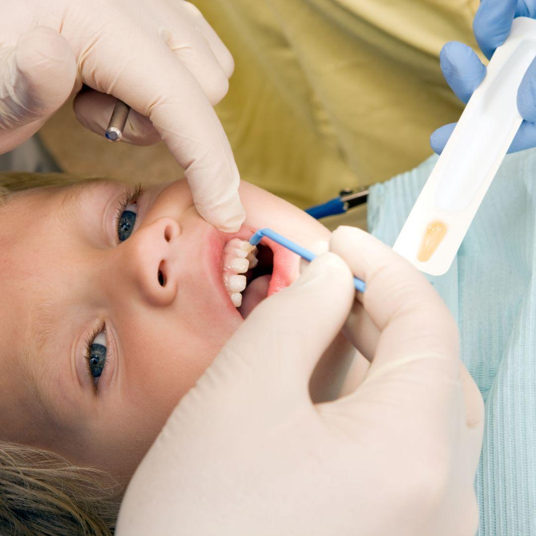 Fluoride Varnish