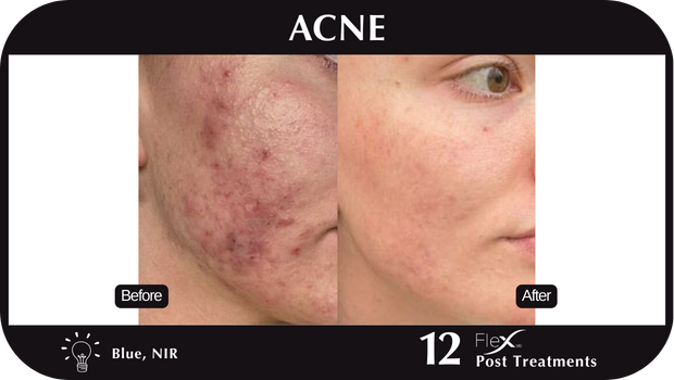 Flex MD Acne