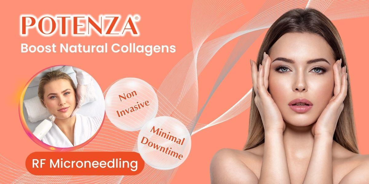 Potenza RF Microneedling