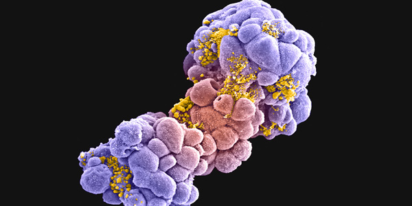 false-colored scanning electron micrograph of a breast tumor spheroid