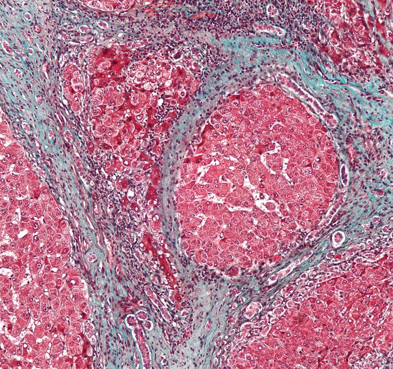 In this stained sample of liver tissue with cirrhosis, bands of fibrotic scarring are shown in blue.
