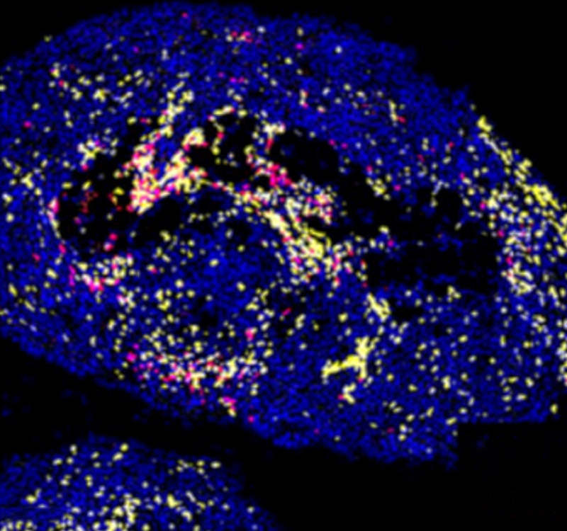 This figure shows the results of treating an aggressive, chemotherapy-resistant ovarian mouse tumor model with an FAK inhibitor and/or a chemotherapy called Pegylated liposomal doxorubicin or PLD. Compared with untreated mice labeled as vehicle (Veh), the combined treatment led to controlled tumor growth while modifying the immune response to increase the infiltration of T and B cells. Image credit: David Schlaepfer, Kevin Tharp.