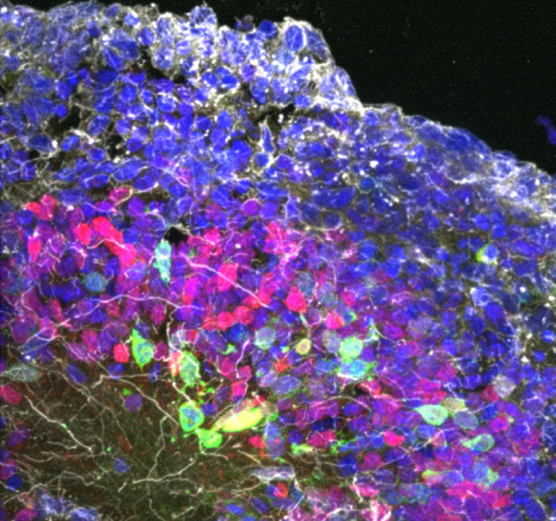 The scientists studied brain organoids derived from patients suffering from a newly discovered genetic disease. These organoids had a more disorganized structure and fewer properly patterned developing nerve cells than healthy controls, suggesting impaired brain development. Image credit: Fang Yuan, Su-Chun Zhang, Sanford Burnham Prebys.
