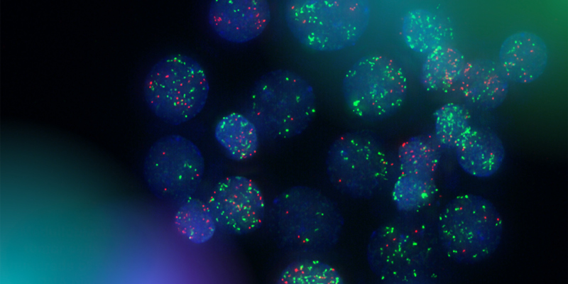 The Chavez lab uses fluorescent markers to observe circular extra-chromosomal DNA elements floating in cancer cells. Research has shown that these fragments of DNA are abundant in solid pediatric tumors and associated with poor clinical outcomes