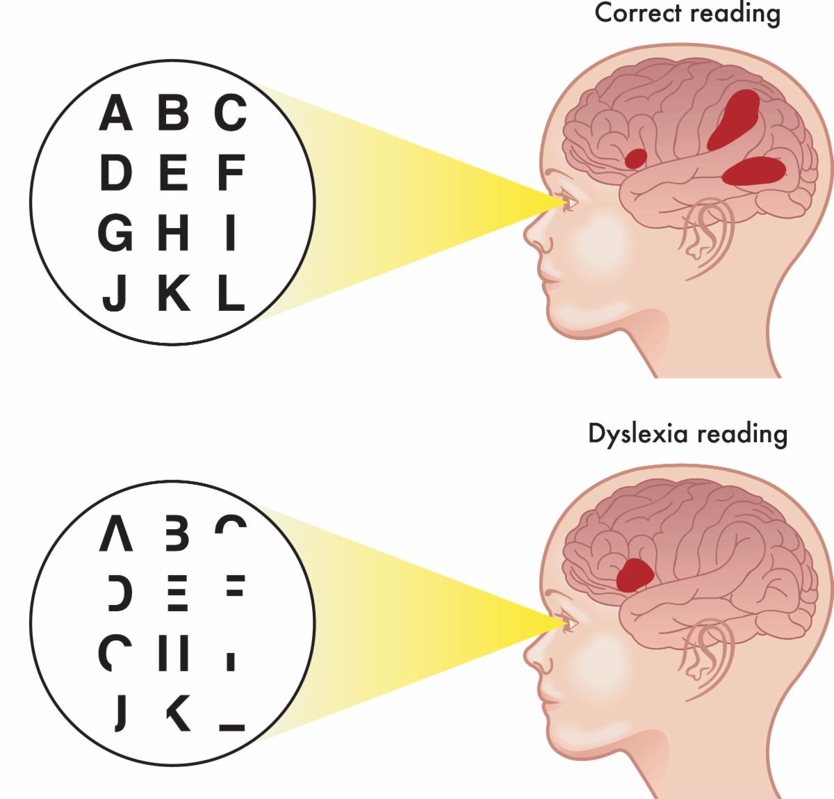 Dyslexia Vision Problems Friday Nite Friends