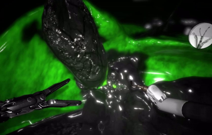 Robotix Firefly_on_Cholecystectomy.png