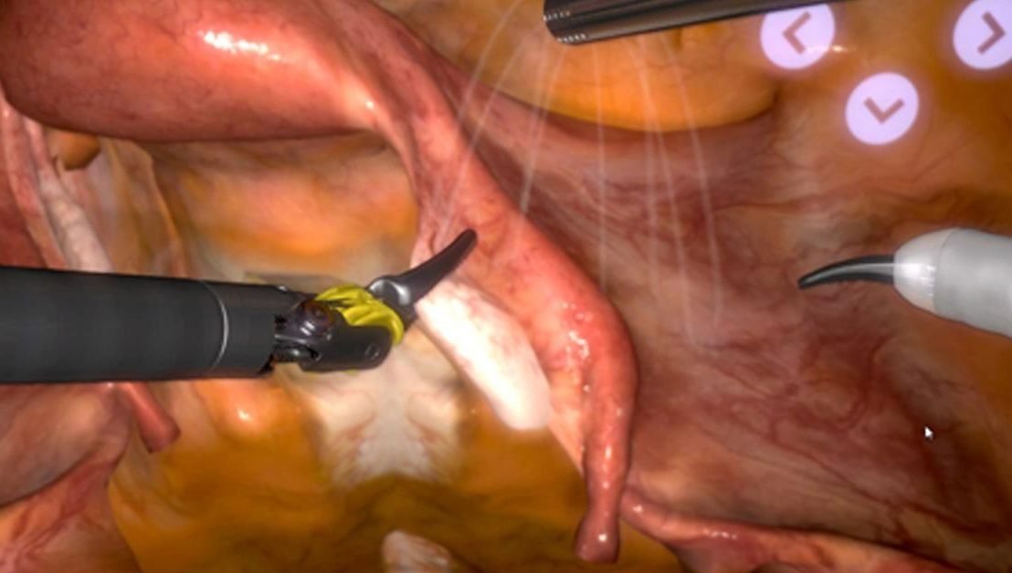 SERGS Hysterectomy.jpg