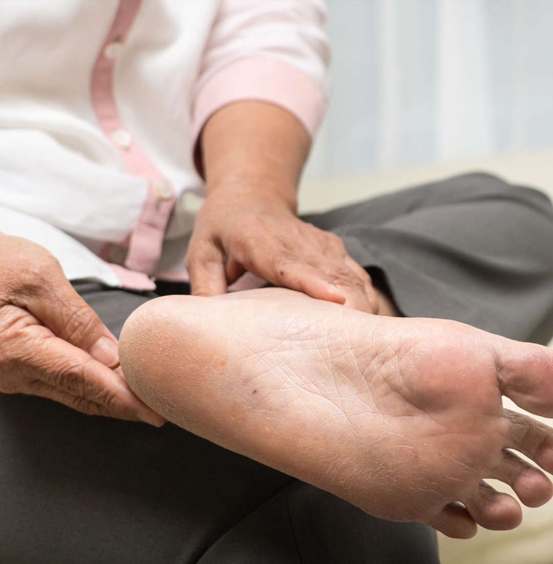 Read: Preventing Diabetic Foot Problems