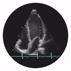 A beating heart, as shown in a heart ulstrasound.