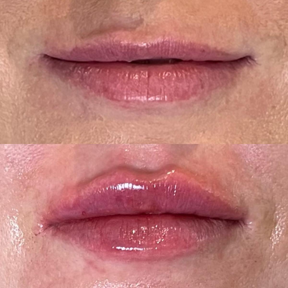 Juvederm & Botox on special at Glosshouz