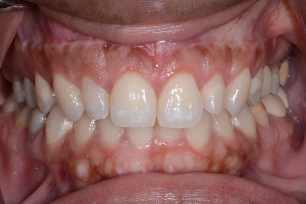 3 month post-op esthetic crown lengthening