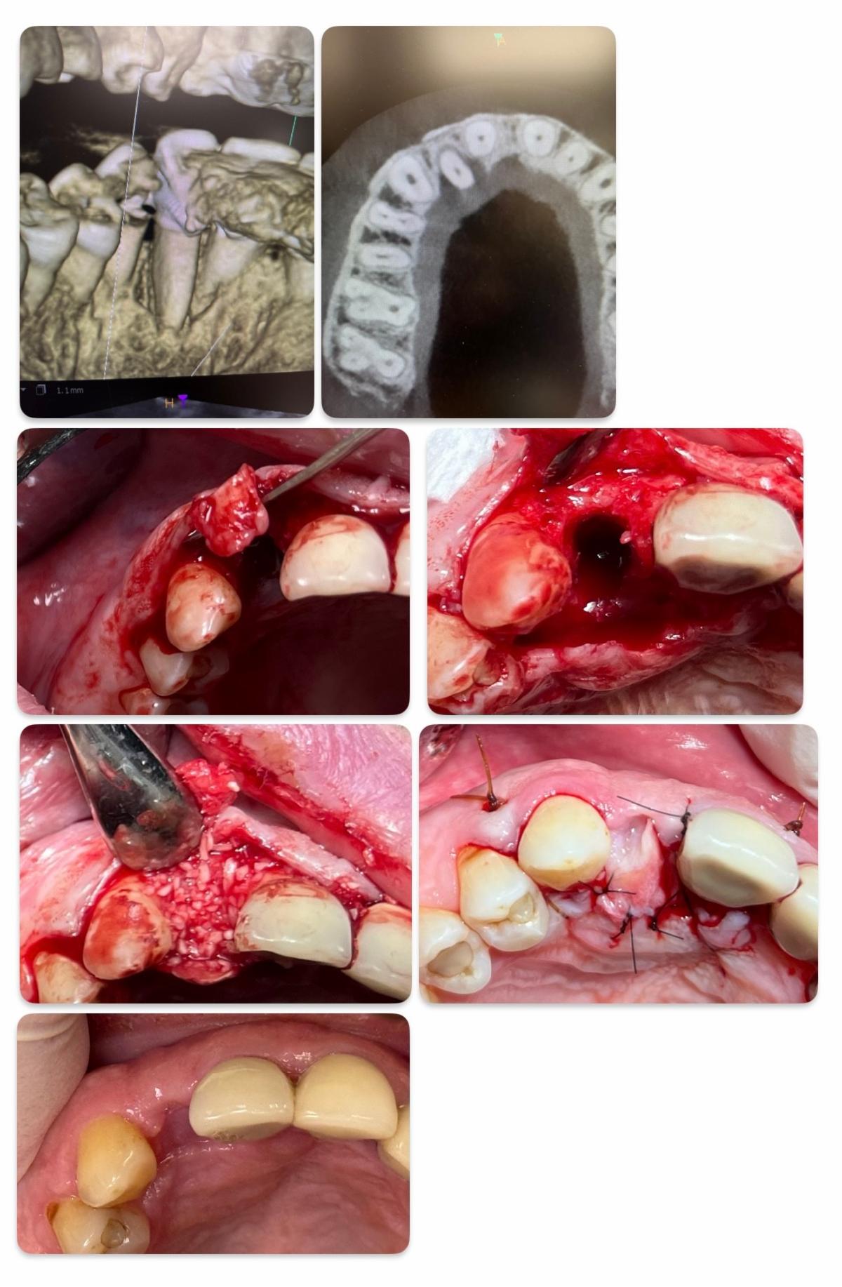 Case 2 - Delayed grafting