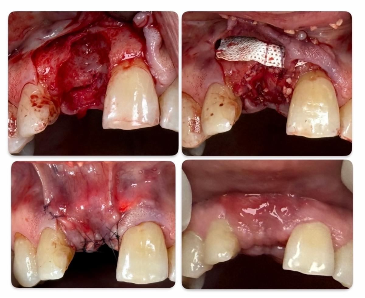 Case 1 - Immediate grafting