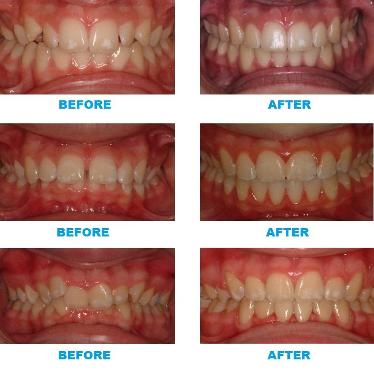 Real Before & After Braces Pics Inside