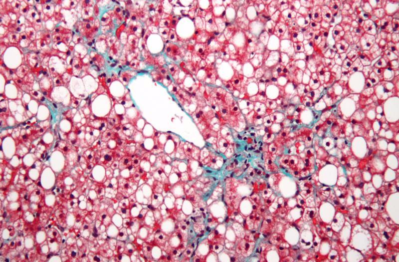 fatty_liver_acid