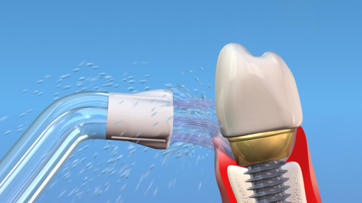 Water Flossers Top Choice for Implant Maintenance