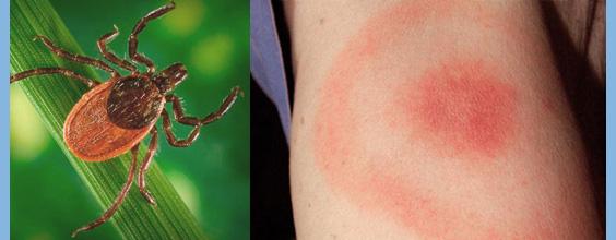 Lyme disease
