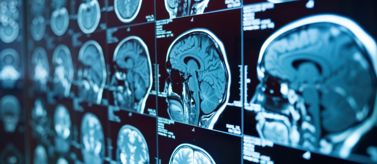 The image shows a brain scan with various colors and patterns.