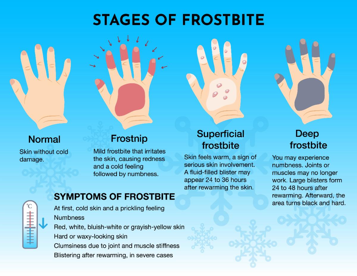 Medical frostbite stage and first aid infographic. Frozen hands with fingers.