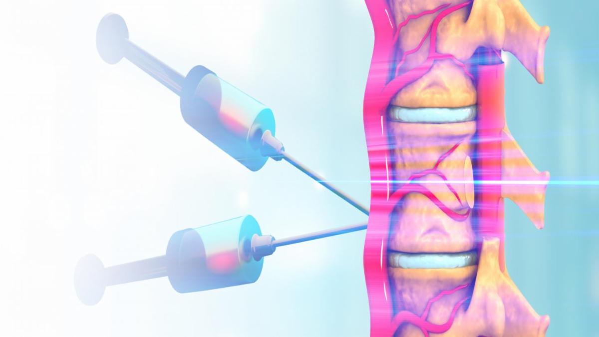 Illustration of spinal cord with needles