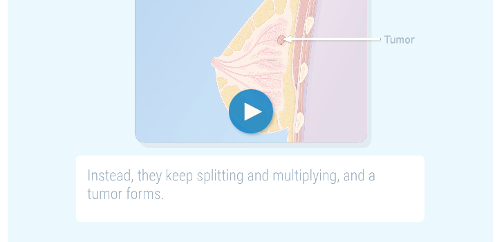 video thumbnail with illustration of breast cross-section and visible tumor.