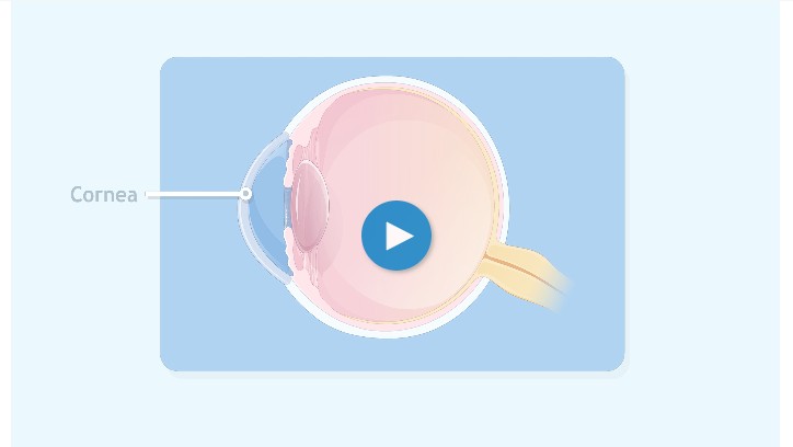 An illustration of a cross section of an eye, highlighting the cornea, with a play button centered on the diagram.